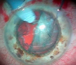 Хирургия катаракты - удаление катаракты в Москве